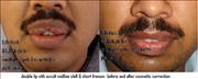 Before After Pictures,Cosmetic surgery,Delhi, double lip